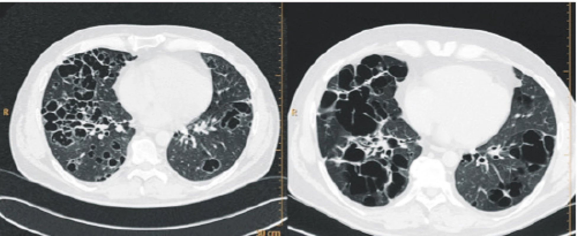 Pokročilá forma plicní HRCT plic<br>
Nodularity přecházejí v kavitované nodularity, později v cysty, které
mají tendenci ke splývání. A velké plicní cysty pak mohou být příčinou
spontánního pneumothoraxu. U tohoto pacienta byla diagnóza
stanovena až po třetím spontánním pneumothoraxu, kdy byla
provedena thorakoskopie a odběr vzorku na histologii.
