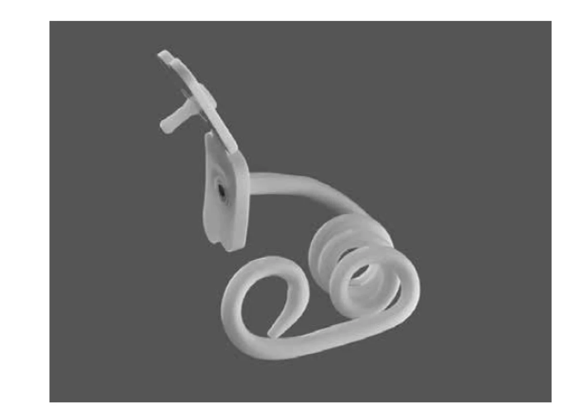 Chait Trapdoorův katétr používaný k endoskopické
cékostomii nebo LAPEC<br>
Fig. 8: Chait Trapdoor catheter used for endoscopic cecostomy
or LAPEC