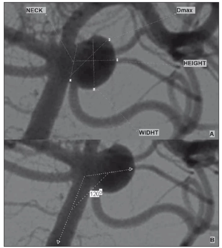 (A) Example of aneurysm morphological parameters; (B) aneurysm input angle
measurement.<br>
Obr. 1. (A) Příklad morfologických parametrů aneuryzmatu; (B) měření angulace
aneuryzmatu.