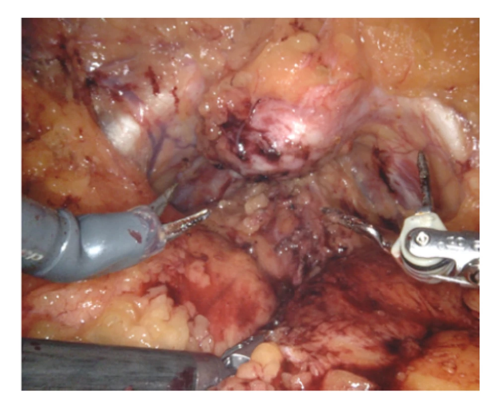 Peroperační obrázek. Optika 30° rotovaná dorzálně;
na horní části obrázku nad linií a mezi nástroji (nůžky a bipolární
grasper Maryland™) je patrná protuberance<br>
Fig. 2. Picture form surgery. Optic 30° rotated ventrally;
protuberance is visible in the upper part of figure
over line and between instruments (scissors and bipolar
grasper Maryland™)