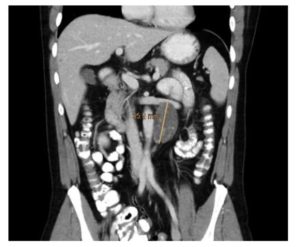Paket lymfatických uzlin retroperitonea vlevo<br>
Fig. 1. Left retroperitoneal lymph node packet