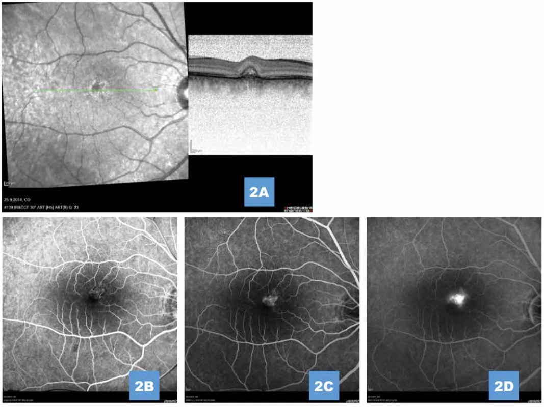 (A) Komplikující drobná klasická porce sekundární choroidální neovaskularizace 1 měsíc po provedené fotodynamické terapii (B,C,D) Průkaz vysoce aktivní choroidální neovaskularizace na fluorescenční angiografii
