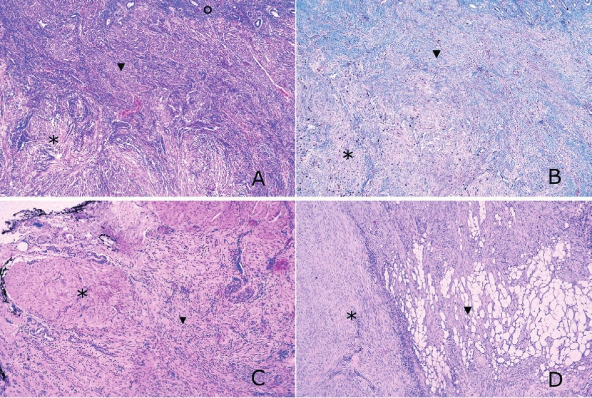 Histologický obraz a proliferační aktivita v disekujícím leiomyomu dělohy.<br>
A: Řez zachycující endometrium (), myometrium () a intramurální složku disekujícího leiomyomu () (barvení hematoxylin-eozin, zvětšeno
200x).<br>
B: Mírně vyšší proliferační aktivita Ki-67 v disekujícím leiomyomu () ve srovnání s přilehlým myometriem () (imunohistochemie, zvětšeno
200x).<br>
C: Svalová vrstva stěny ureteru () infiltrovaná extramurální složkou disekujícího leiomyomu () (barvení hematoxylin-eozin, zvětšeno 200x).<br>
D: Intramurální () i extramurální složka disekujícího leiomyomu s patrnou infiltrací tukové tkáně parametrií () (barvení hematoxylin-eozin,
zvětšeno 200x).