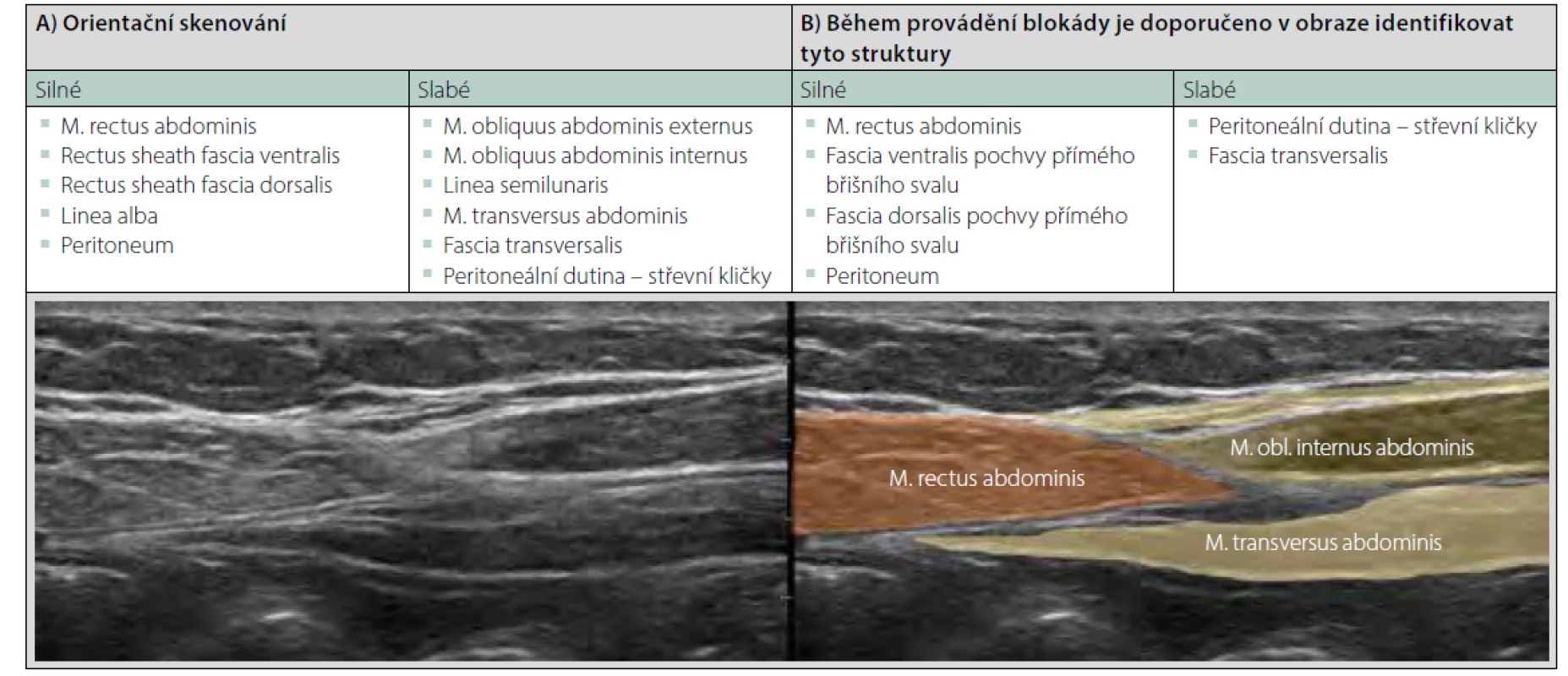 Rectus sheath plane block