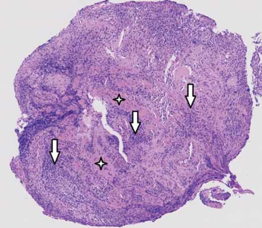 Histological examination – base of ulceration consisting of granulation
tissue with mixed inƪ ammatory infiltrate.<br>
Obr. 2. Histologické vyšetření – spodina ulcerace tvořená smíšeně zánětlivě
celulizovanou granulační tkání.