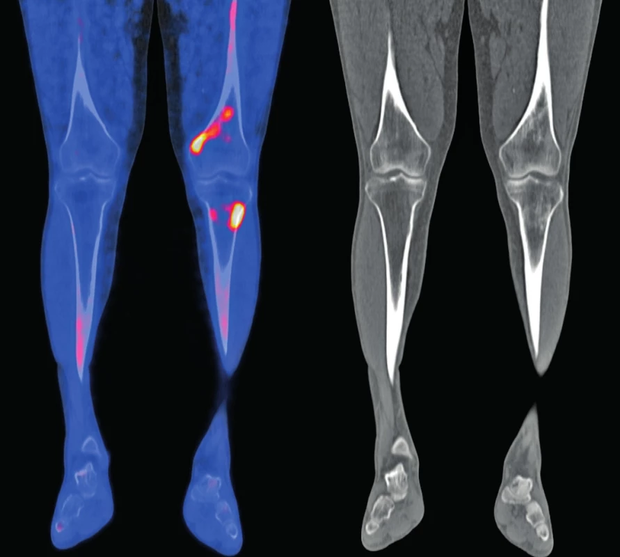 Snímek druhého pacienta<br> 18F-NaF-PET/CT obraz dolních končetin, koronární řezy: v distální části levého femuru (diafýza, epifýza) jsou patrné nevýrazné, nehomogenní okrsky sklerotizace, jen některé vykazují zvýšenou akumulaci 18F-NaF v PET/CT obraze. Maximum změn je v periférii kosti. Obdobný, více denzní nález je v CT obrazu také ve ventrálním okraji proximálního okraje levé tibie. V obdobné lokalizaci jsou diskrétní změny kostní struktury také v pravém femuru a pravé tibii.