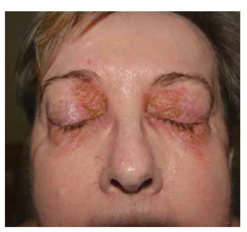 Pemphigus foliaceus, postižení periorbitálně