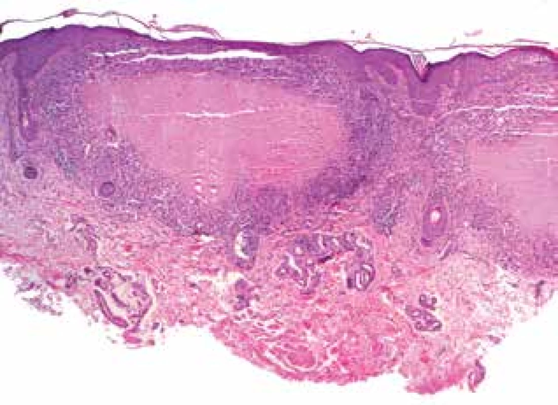 Lupus miliaris disseminatus faciei: kaseifikující granulomy
(HE 40x)