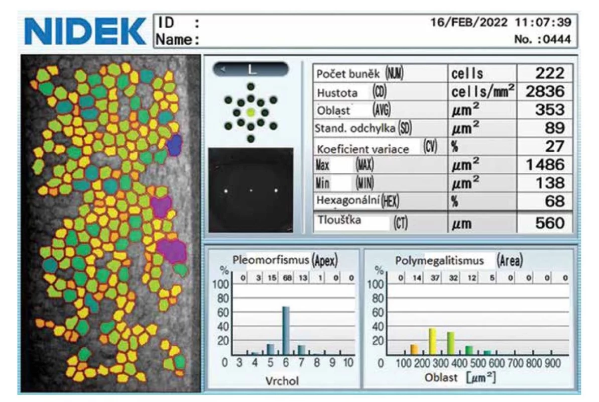 Příklad vyhodnocení průměrného počtu endotelových buněk pomocí endoteliálního mikroskopu Nidek CM-530 [16]
