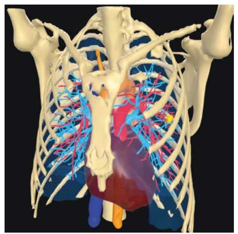 CT 3D rekonstrukce pro rozšířenou a virtuální realitu,
žlutě znázorněn tumor před segmentektomií linguly<br>
Fig. 1: CT 3D recontruction for augmented and virtuál
reality, yellow marked tumor before segmentectomy of
lingula