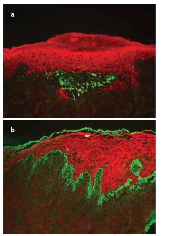 Přímá imunofluorescence lichen planus<br>
a) pruhovitá, cárovitá imunofluorescence fibrinogenu podél
bazální membrány,<br>
b) IgM pozitivní cytoidní tělíska ve shlucích subepidermálně