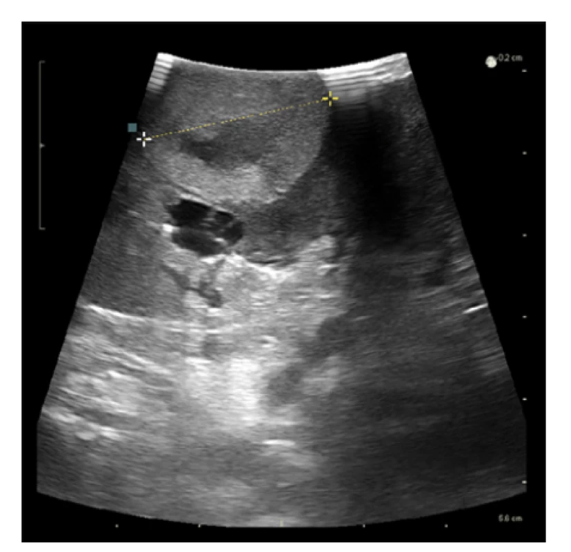 Využití perioperační ultrasonografie při laparoskopické
resekci tumoru solitární ledviny<br>
Fig. 3. The usage of perioperative ultrasonography during
a laparoscopic partial nephrectomy of solitary kidney