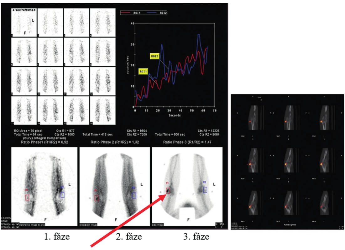 Přínos SPECT/CT – upřesnění
patologické léze k anatomické struktuře
(3F loktů – známky epikondylitis lateralis
(radialis) vpravo)
