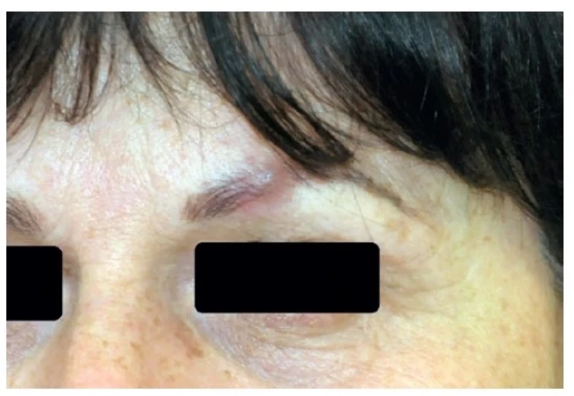 Palpačně měkké špatně ohraničené ložisko bez
povrchových změn<br>
Fig. 1: Poorly demarcated lesion, soft on palpation,
without any superficial changes