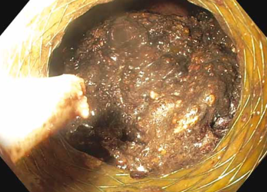 Horní endoskopie – pohled do nekrotické dutiny
přes lumen metalického stentu s patrnými černohnědými
nekrotickými hmotami.<br>
Fig. 5. Upper endoscopy – view to the necrotic cavity through
a metallic stent lumen with visible black-brown necrotic
masses.