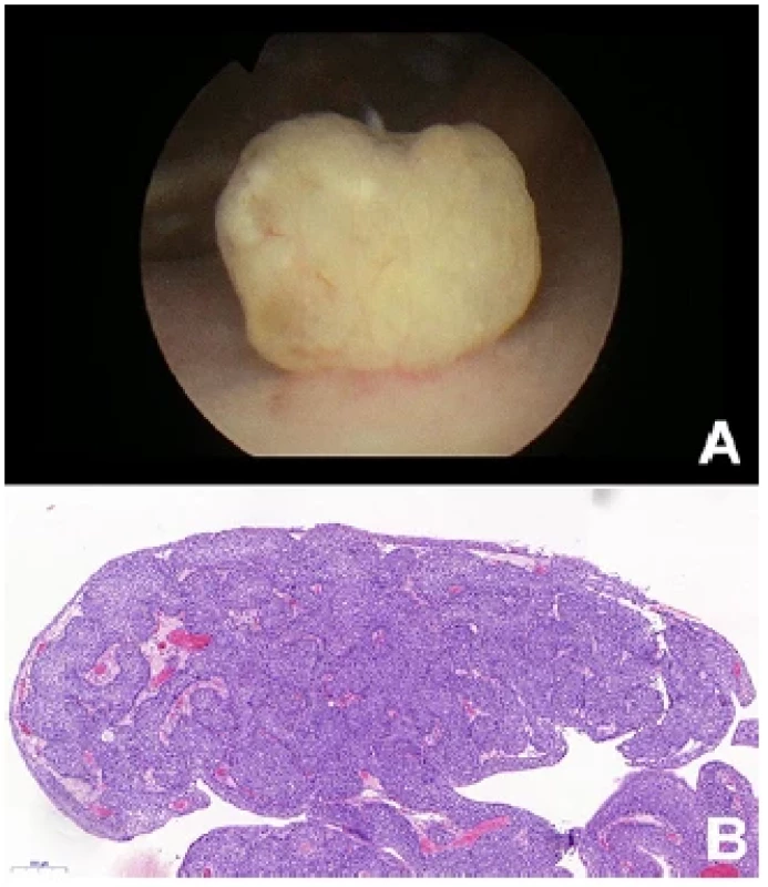 Invertovaný uroteliální papilom při cystoskopickém
vyšetření (A), mikroskopický nález (B) <br> 
Fig. 1. Inverted urothelial papiloma on cystoscopy (A),
histological appearance of inverted papilloma, staining
hematoxylin-eosin (B)