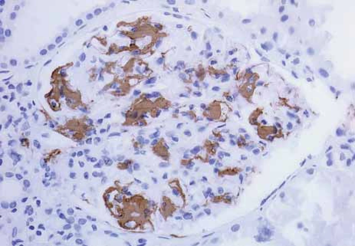 Histologické nálezy u pacientů s IBD a renálním postižením (tubulointersticiální nefritida, glomerulonefritida, AA amyloidóza).<br>
Fig. 11. Biopsy pictures in IBD patients with renal illness (tubulointerstitialnephritis, glomerulonephritis, AA amyloidosis).