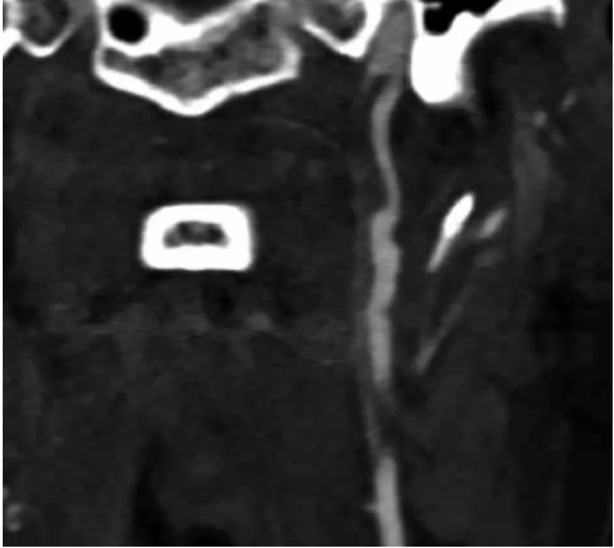 Akutní trombóza ACI sin. na CTAg v předozadní projekci <br>
Fig. 1. Acute thrombosis ACI sin. on CTAg in anterior-posterior projection
