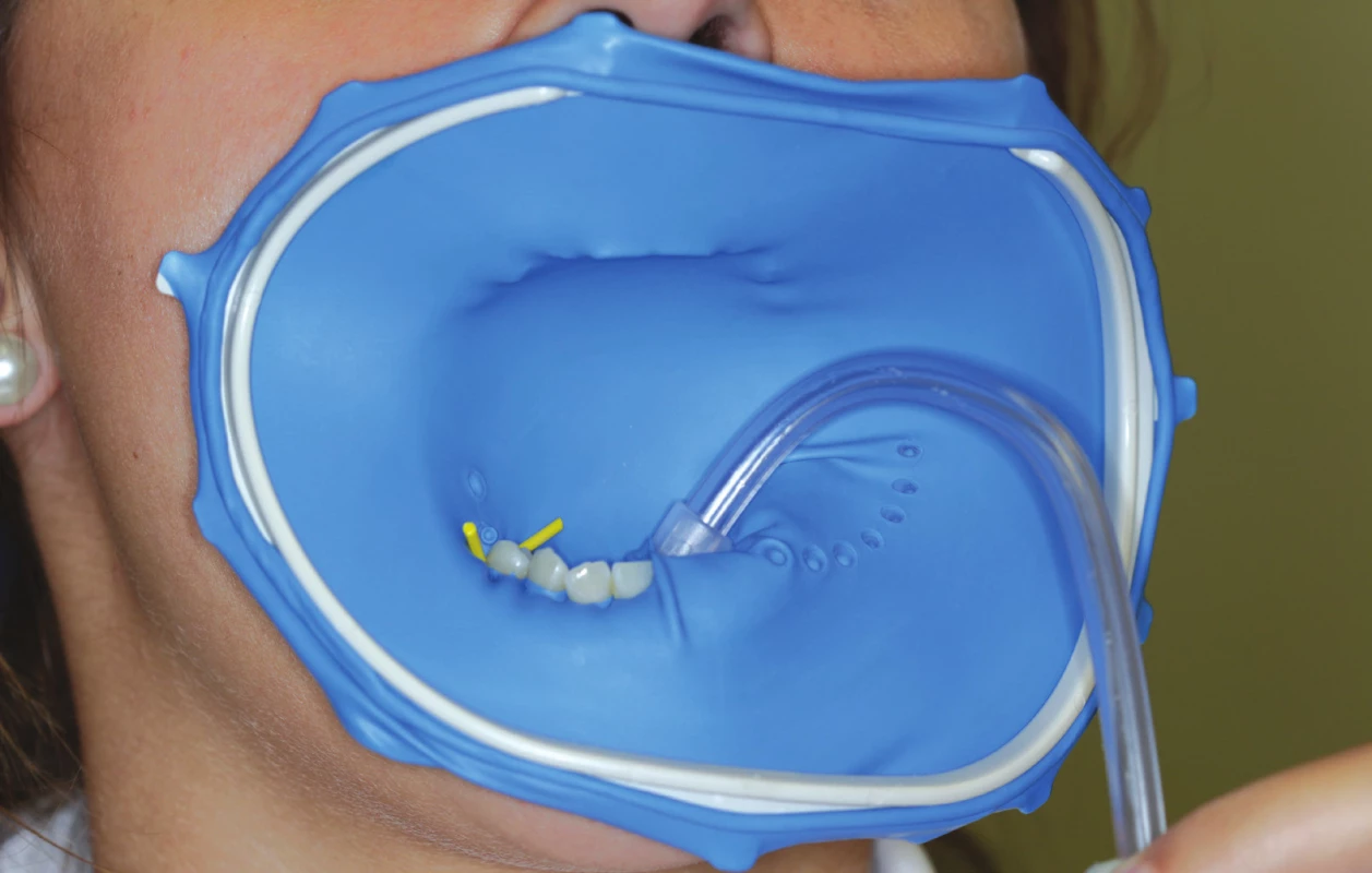 OptiDam<br>
Fig. 2 OptiDam