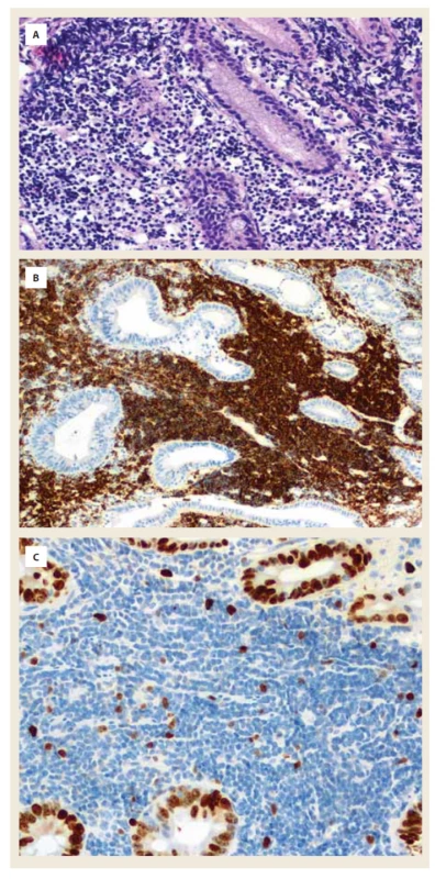 Histologické vyšetření bioptovaných
vzorků odebraných v místě stenózy
proximálního jejuna.<br>
A) Barvení hematoxylinem-eozinem;
zvětšení 200x: detail infiltrace střevní
sliznice denzní lymfoidní infiltrací.<br>
B) Barvení na CD20 (typické pro zralé
B-lymfocyty); zvětšení 200x: silná
membránová pozitivita CD20 v denzním
lymfoidním infiltrátu.<br>
C) Barvení na Ki67 (průkaz proliferační
aktivity buněk); zvětšení 200x: nízká
proliferační aktivita v denzním lymfoidním
infiltrátu, ve srovnání s okolní
střevní sliznicí s vysokou proliferační
aktivitou.<br>
Fig. 2. Histological examination of biopsied
samples taken at the site of proximal
jejunal stenosis.<br>
A) Hematoxylin-eosin staining; magnification 200x: 
detail of intestinal mucosal
infiltration by dense lymphoid
infiltration.<br>
B) Staining for CD20 (typical of mature
B cells); 200x magnification: strong
membrane positivity of CD20 in dense
lymphoid infiltrate.<br>
C) Staining for Ki67 (demonstration of
cell proliferative activity); 200x magnification:
low proliferative activity in the
dense lymphoid infiltrate, compared to
the surrounding intestinal mucosa with
high proliferative activity.