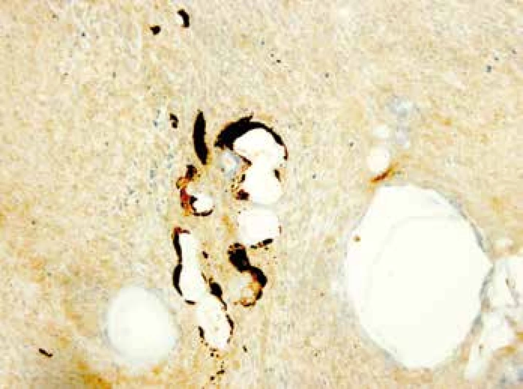Cytokeratin pozitivní materiál v malých dutinkách nekrotické tkáně v punkční biopsii z jater (Imunohistochemická reakce s CK 7, původní zvětšení 250x).