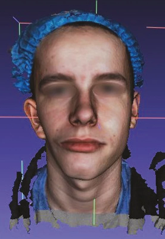 Neupravený 3D faciální sken
15letého pacienta s OAVS
z obr. 3
(obrazová dokumentace
oddělení ortodoncie
a rozštěpových vad,
Stomatologická klinika FNKV,
Praha)<br>
Fig. 5
An unadjusted 3D facial scan
of the OAVS 15-year-old
patient of Fig 3
(Department of Orthodontics
and Cleft Anomalies,
3rd Faculty of Medicine,
Charles University
and Kralovske Vinohrady
University Hospital)