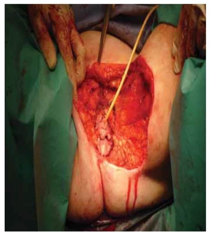 Stav po radikální excizi recidivy.<br>
Fig. 6. Condition after radical excision of recurrence.