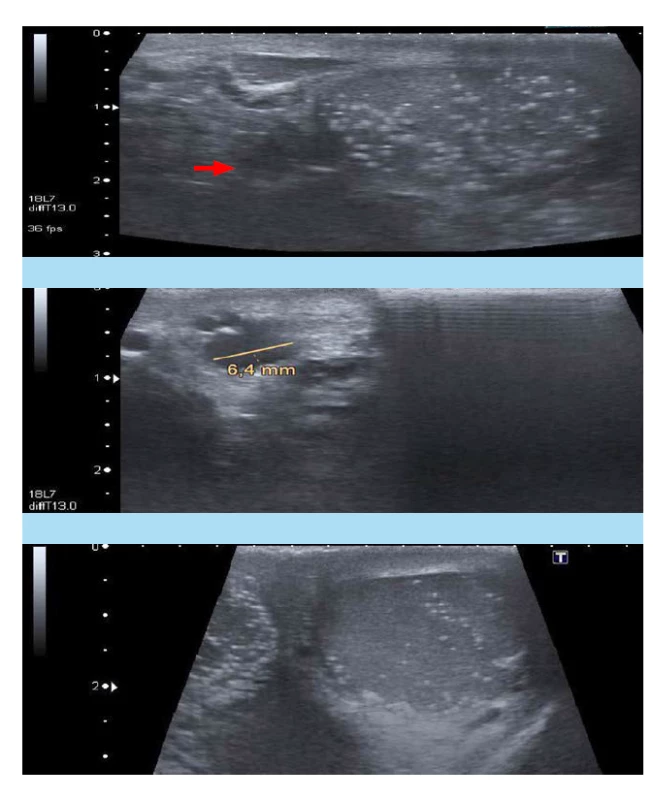 a, b, c. a) USG levého
varlete: testikulární mikrolitiáza,
tři spermatokély v nadvarleti
(červená šipka), b) USG nadvarlete
vlevo: detail spermatokél,
c) USG pravého varlete s mikrolitiázou,
bez jiné patologie (2020,
pacient č. 1)<br>
Fig. 3. a, b, c. a) Ultrasound
examination of the left testis:
testicular microlithiasis, three
spermatoceles of the epididymis
(red arrow), b) Ultrasound
examination of the left testis
and epididymis: detailed picture
of the spermatoceles, c) Ultrasound
examination of the right
testis with microlithiasis, without
other testicular patology (2020,
patient No 1)