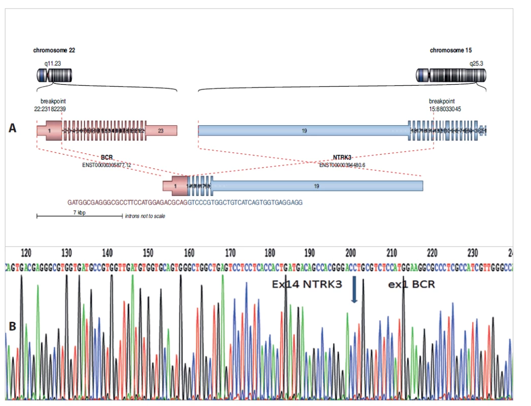 A: Nově diagnostikovaný fúzní gen BCR-NTRK3 u dětské pacientky s low-grade gliomem. Analýza pomocí Arriba software https://github.
com/suhrig/arriba. B: Sekvenační analýza fúzního produktu BCR-NTRK3 pomocí Sangerovy sekvenace.