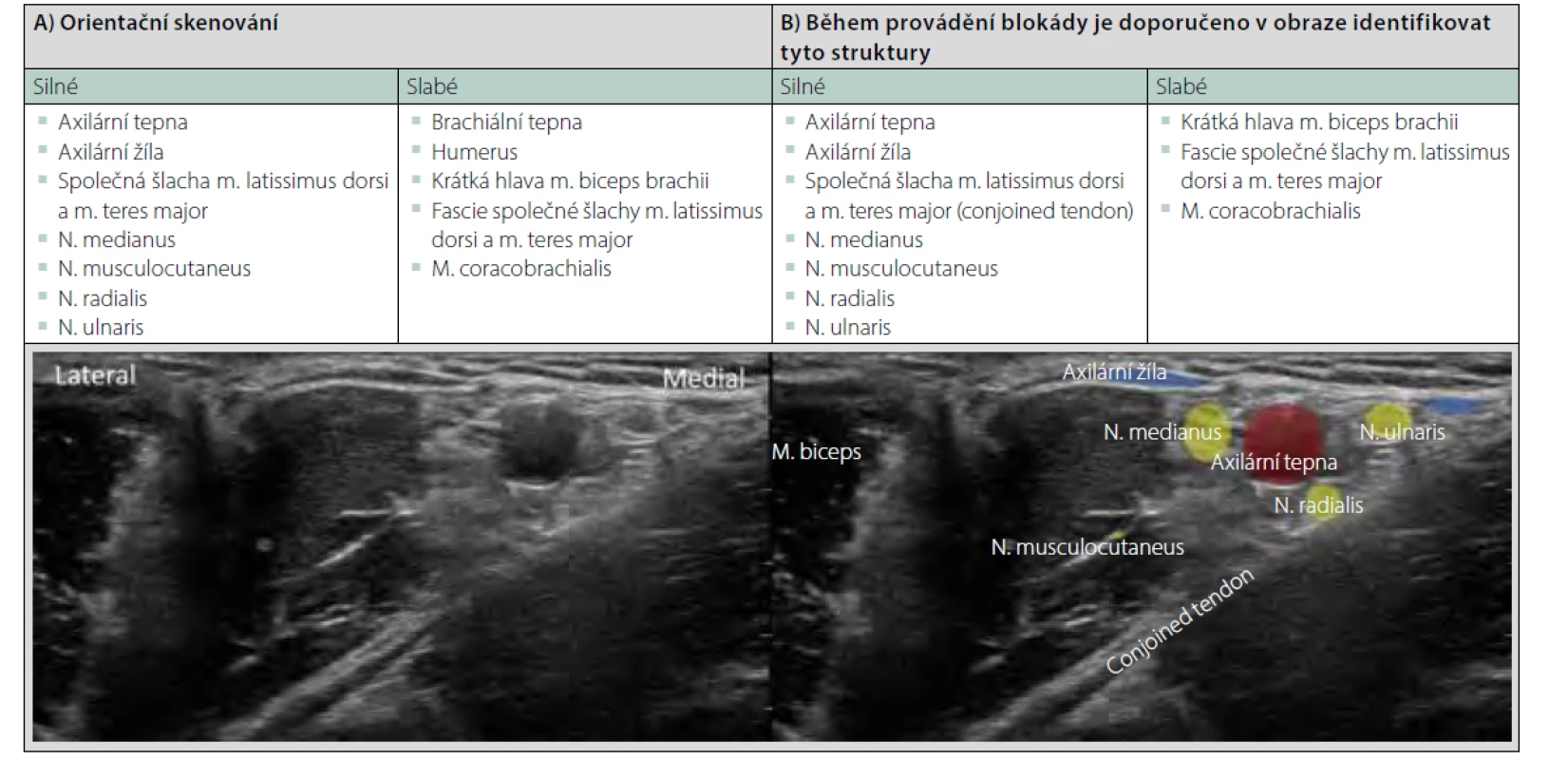 Blokáda brachiálního plexu v oblasti axily