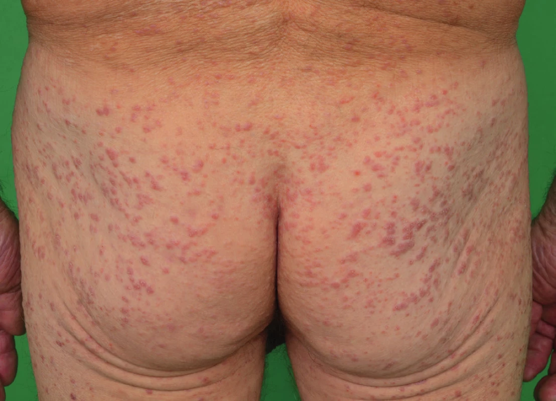 Kožní projevy indeterminate-cell histiocytosis v lednu 2016