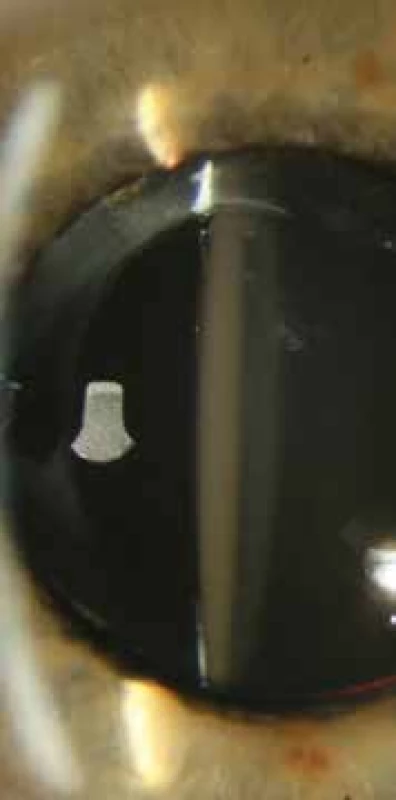 Anterior segment – opacified IOL AcryNovaTMPC
610Y before explantation