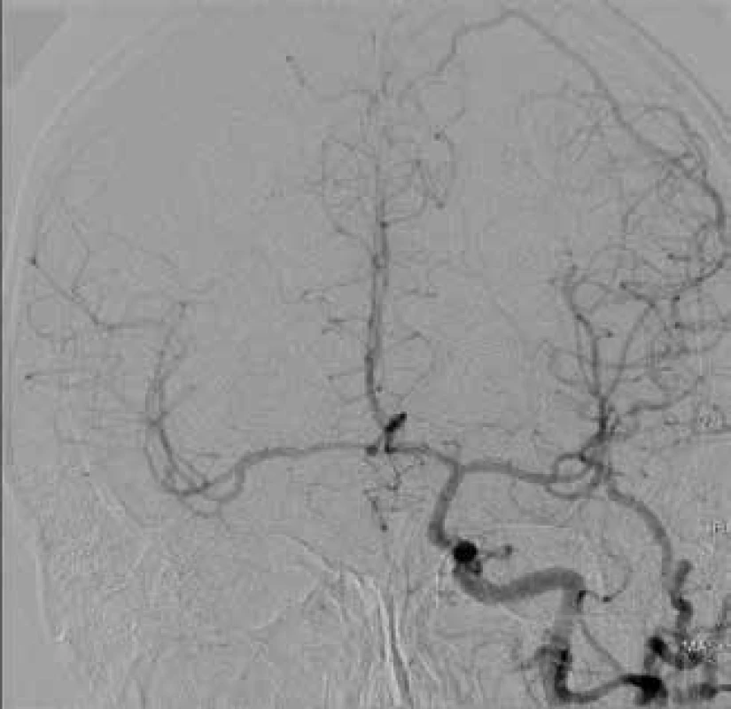 CT angiography of contralateral carotid artery with
compression of affected artery