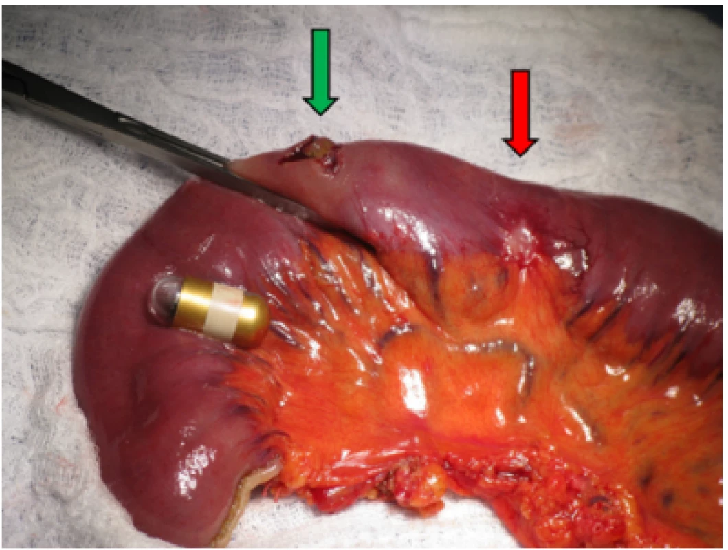 Peroperative view of infiltration of jejunum (red arrow) with the
lodged capsule which was extracted by enterotomy (green arrow)
