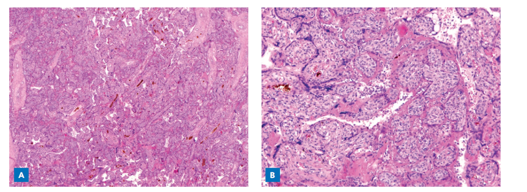 Histopatologické vyšetření placenty (hematoxylin/eosin barvení). Intervilózní prostory jsou obliterovány masivními depozity
fibrinoidu (A). Histiocytární intervillositis (histiocyty místy formují větší skupiny), perivilózní fibrinová depozita, nekróza
syncytiotrofoblastu, stroma klků nepostižené (B).