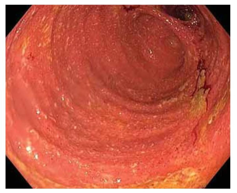 Endoskopie ileálního vaku („pouchoskopie“), pohled
ze střední části těla pouche směrem na jeho vrchol
a k přívodné kličce.<br>
Fig. 1. Ileal sac endoscopy (“pouchoscopy”), a view from
the middle part of the pouch body towards its apex and the
lead loop.