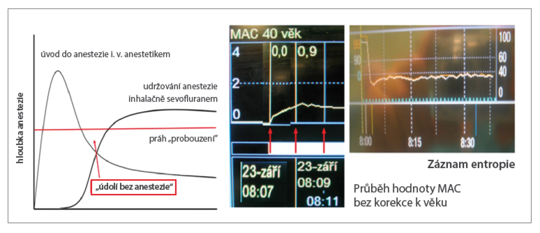 K „údolí bez anestezie“ nedochází ani při použití technik s nízkým FGF již od začátku anestezie,
jak dokumentuje skutečný záznam vzestupu MAC a průběhu entropie u 71letého pacienta s BMI 26,5 po
úvodu etomidátem a sufentanilem podstupujícího koronární revaskularizaci. Aplikace sevofluranu byla
zahájena bezprostředně po intubaci (rocuronium 1 mg/kg), odpařovač nastaven na 8 %, FGF 1 l/min,
FiO2 0,5. Hodnoty MAC 0,8 (chybně nekorigované podle věku) bylo dosaženo za 4 minuty).