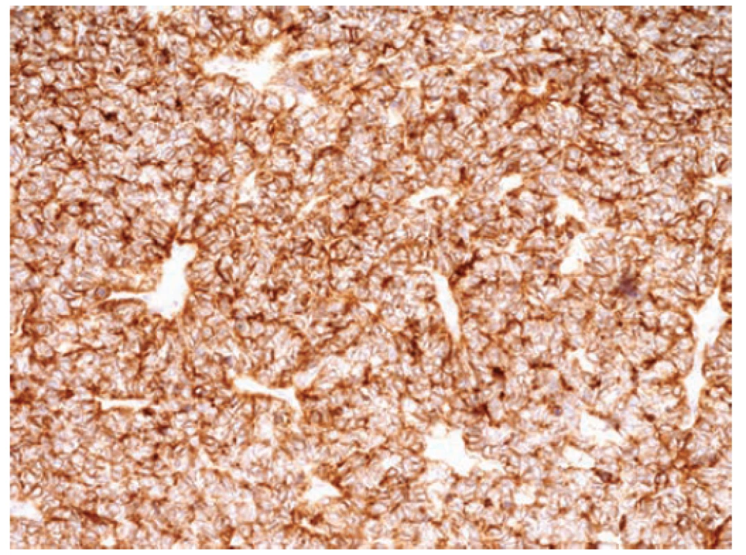 Immunohistochemical detection of high positive
of membrane antigen CD99