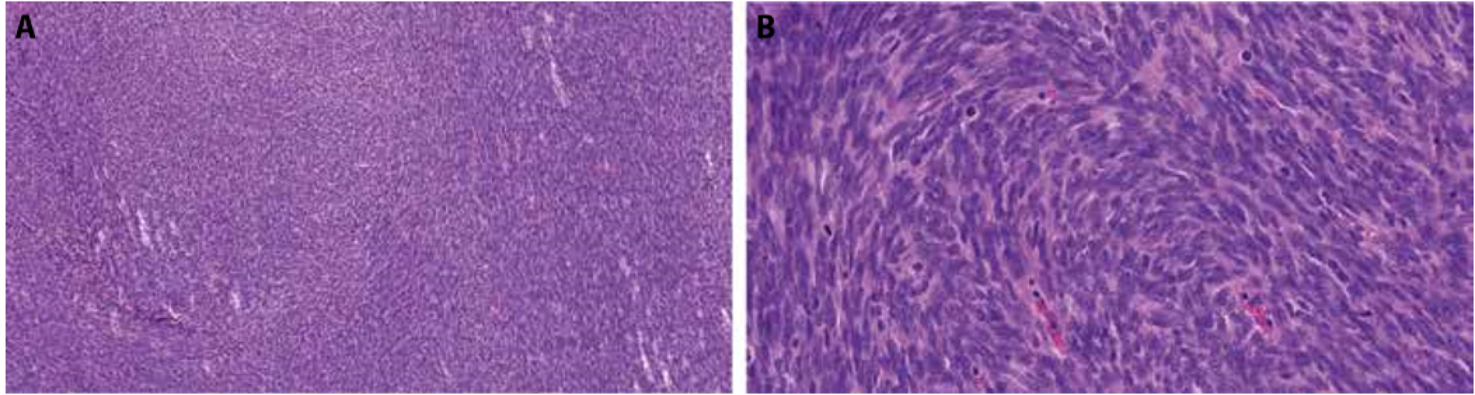 Foto z digitálního scanu histologického preparátu z probatorní biopsie - vřetenobuněčný  fascikulárně uspořádaný tumor s hyperchromními jádry a mitotickou aktivitou. HE, zvětšení 13x (A) a 53x (B).