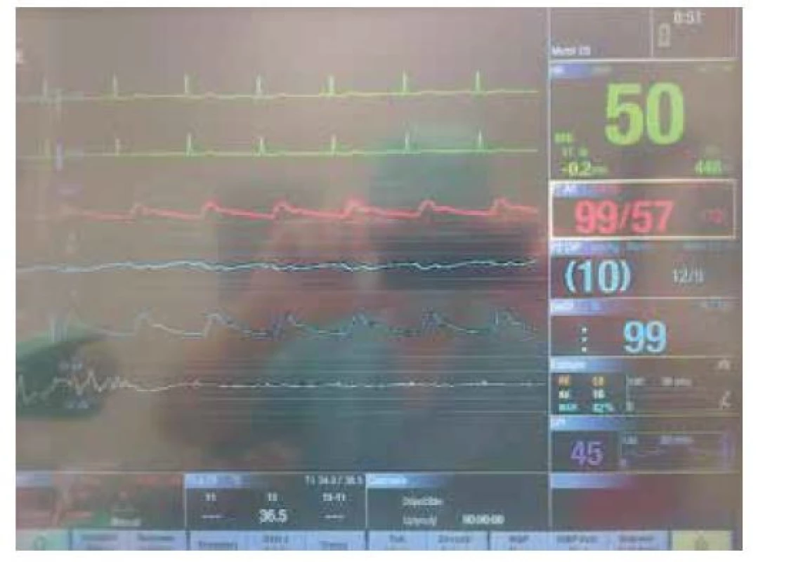 Šestá křivka shora na monitoru zobrazuje syrovou křivku EEG
snímanou monitorem Entropy Module. Vlevo je patrný burst, jenž přechází
do isoelektrické linie přerušované malými kmity, které odpovídají kmitům
R na EKG (kontaminace EEG křivky). Hodnoty RE a SE jsou nízké, tzn. korelují
s obrazem burst suppression a hodnotou BSR 42 %. Fialová hodnota 45 je
Surgical Plethysmography Index (koreluje s úrovní antinocicepce)