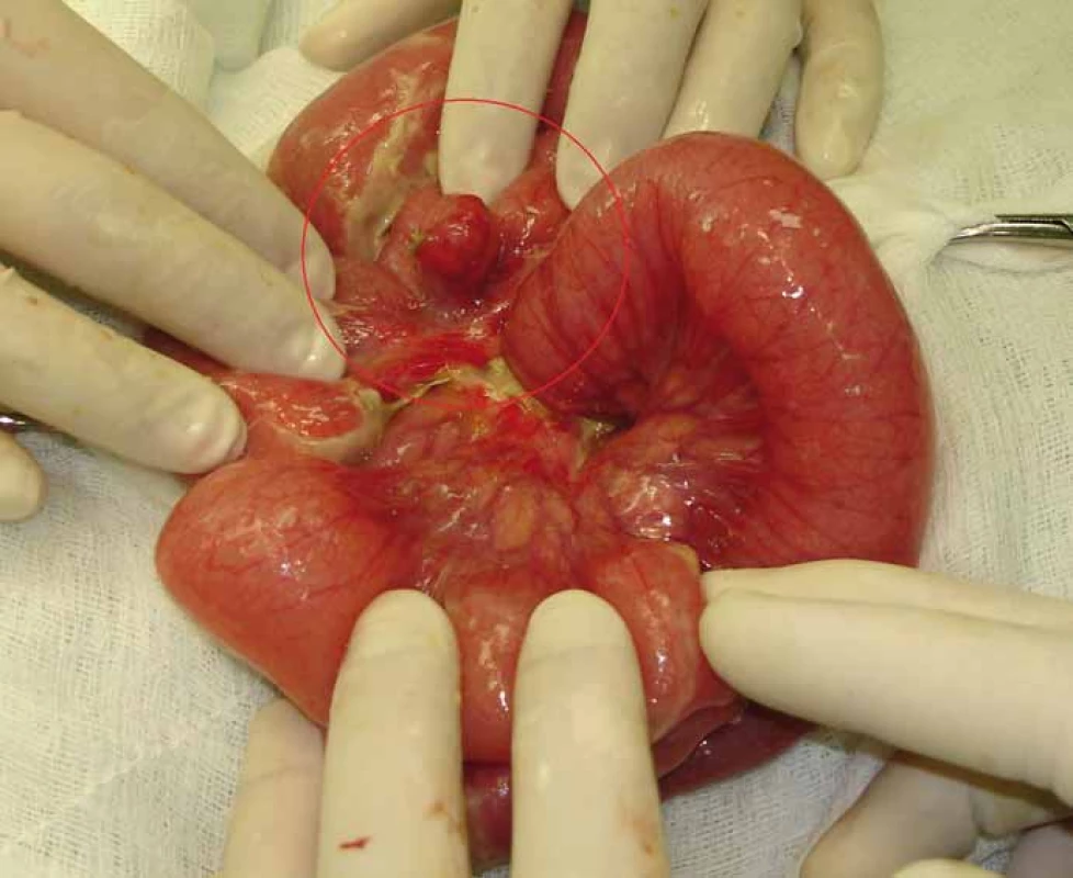 Peroperační nález zánětem postiženého Meckelova divertiklu.
Fig. 1. Per-operative finding of inflamed Meckel’s diverticulum.