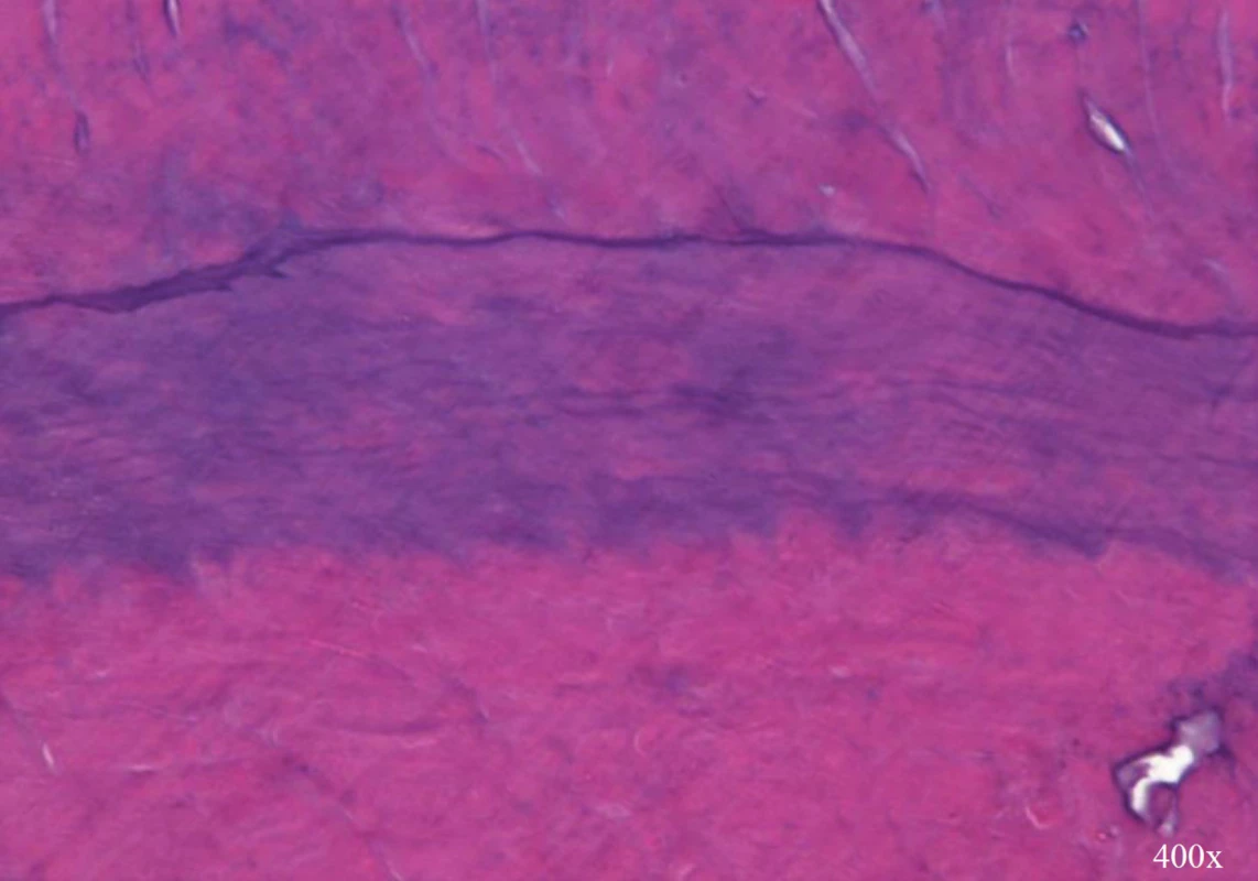 Basophilic transition line between dentin (up) and newly produced mineralized tissue with no tubular structure (down) (magnification 400×)