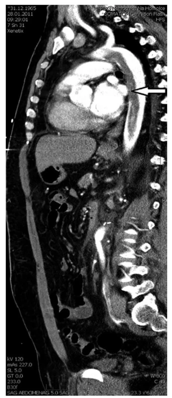 Rozsáhlý nasedající trombus hrudní aorty (CT-AG)<br>
Fig. 6: An extensive mural thrombus in the thoracic aorta
(CT-AG)