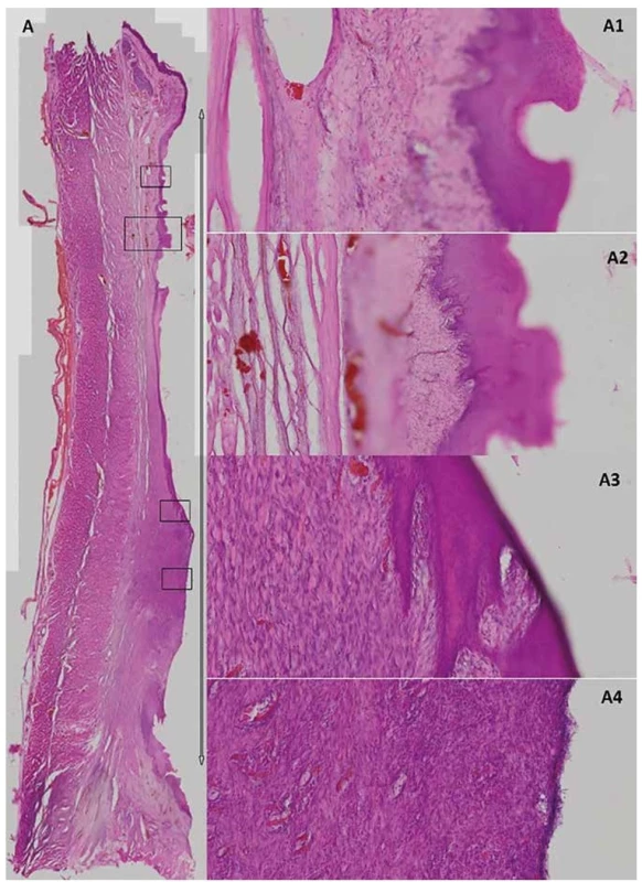 Bright-field microscopy of the post-CED defect in experimental animal T79<br>
The whole esophagus section in the post-CED defect site (A) which is delimited by the arrow (1.51x magnification). Details from
different parts of the CED defect with different grades of re-epithelization (A2>A1>A3>A4; A1, 3, 4=100x magnification; A2=50x
magnification).