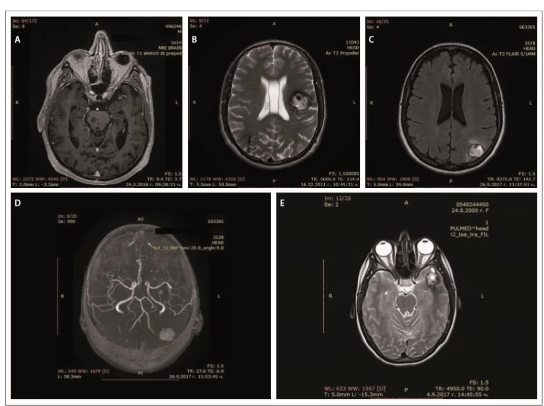 MRI of cerebral cavernous malformations – father (A), son (B), daughter (C, D), granddaughter (E).<br>
Obr. 2. MR cerebrálních kavernózních malformací – otec (A), syn (B), dcera (C, D), vnučka (E).