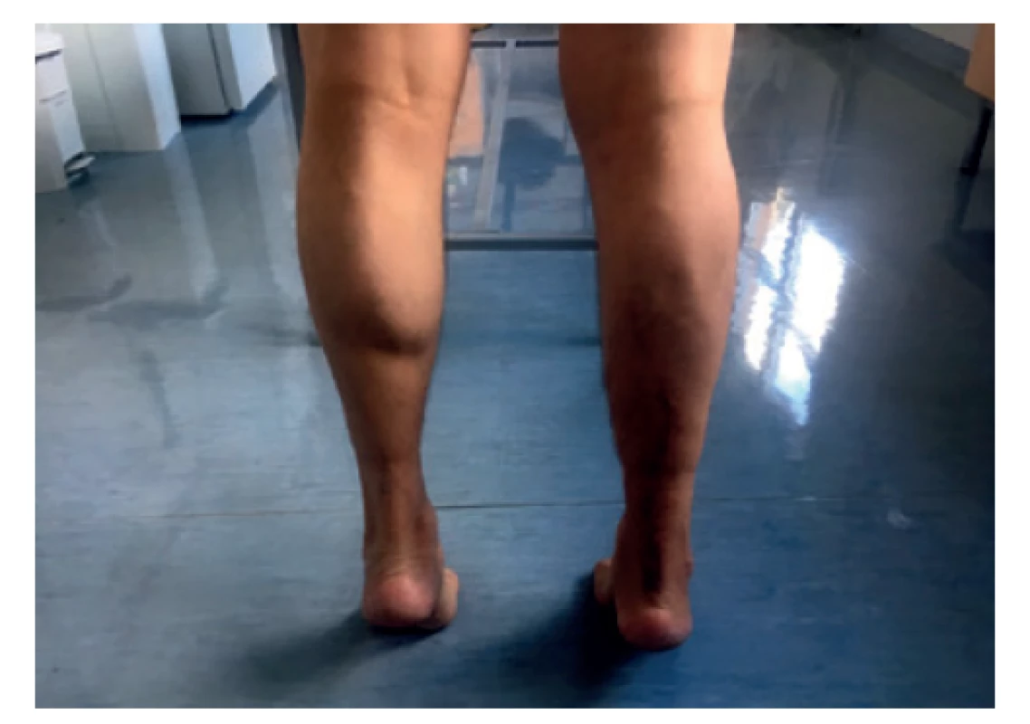 Plné zatížení po 12 měsících od výkonu<br>
Fig. 9: Full weight-bearing 12 months from the surgery