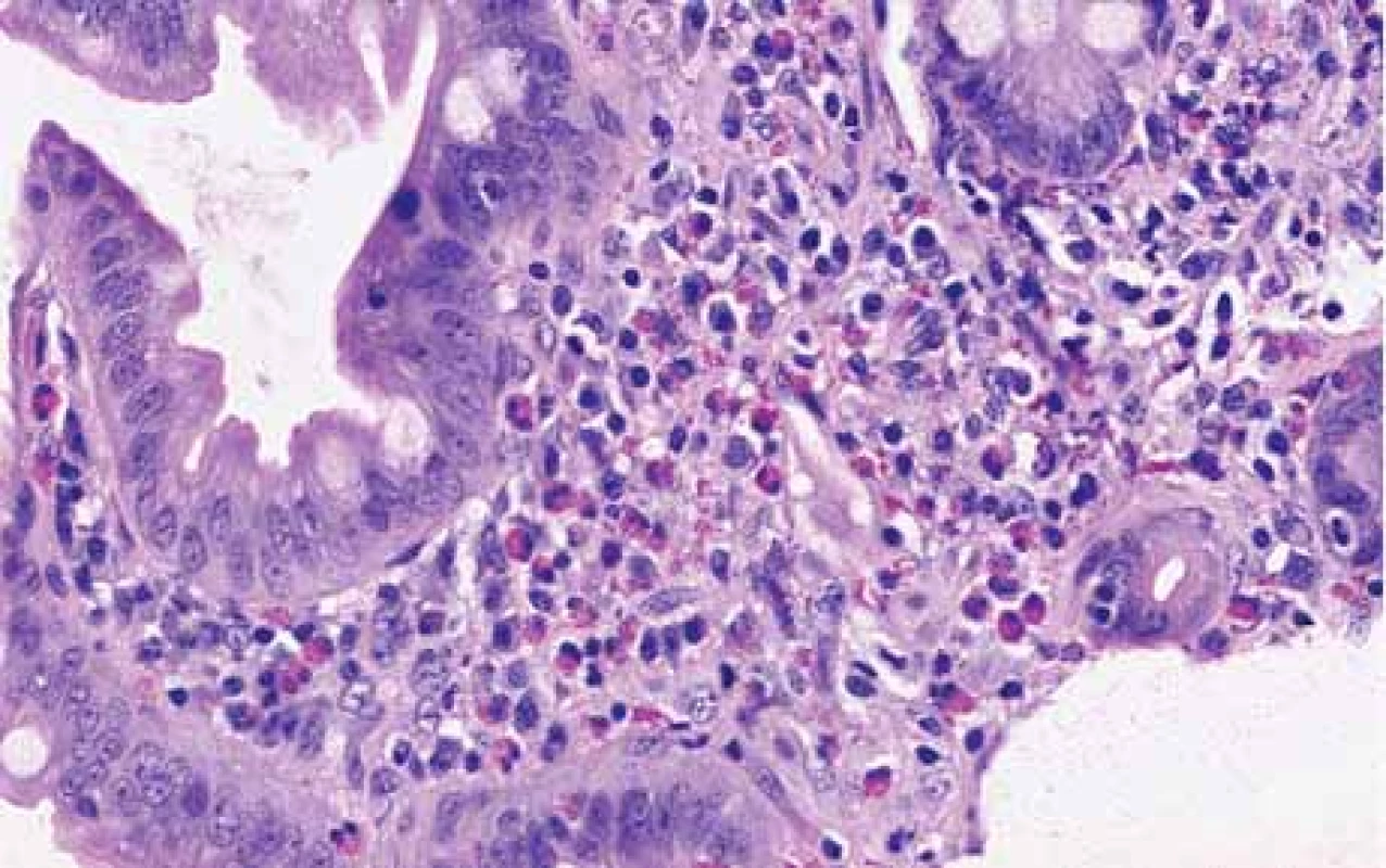 Biopsy from duodenum shows increased eosinophils, hematoxylin and
eosin stain, magnifi cation 200×.<br>
Obr. 4. Histopathologický průkaz zvýšeného počtu eozinofi lů ve sliznici duodena,
barvení hematoxylin-eosinem, zvětšení 200×.