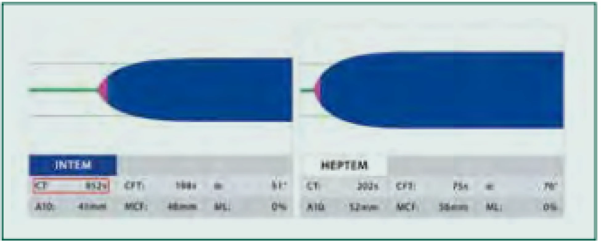 Vliv heparinu: Provedený test INTEM s patologicky prodlouženým
parametrem CT (červený rámeček, normální hodnoty 100–240 s) značí jednak
deficit koagulačních faktorů, ale může znamenat též vliv heparinu. K odlišení
je proveden test HEPTEM s heparinázou. Normalizace parametru CTHEPTEM
potvrzuje vliv heparinu a v terapii tak přichází v úvahu protamin. Pokud je
tento parametr patologický, je nutné substituovat koagulační faktory