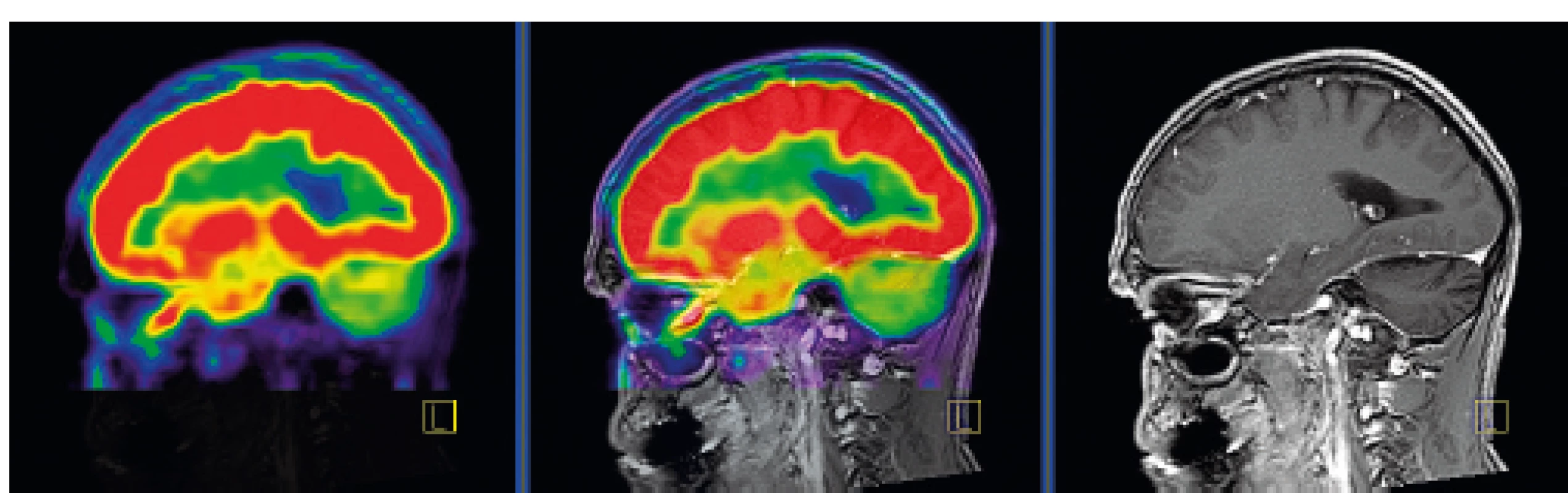 PET CT zobrazení mozku, červená barva znázorňuje intenzivní
akumulaci fluorodeoxyglukózy (FDG), zatímco zelená barva odpovídá
snížené akumulaci FDG<br>
V oblasti cerebella, které je postiženo neurodegenerativními změnami,
je zřetelné snížené vychytávání FDG a neurodegenerativní změny byly
u tohoto pacienta zřetelné i na MR zobrazení.