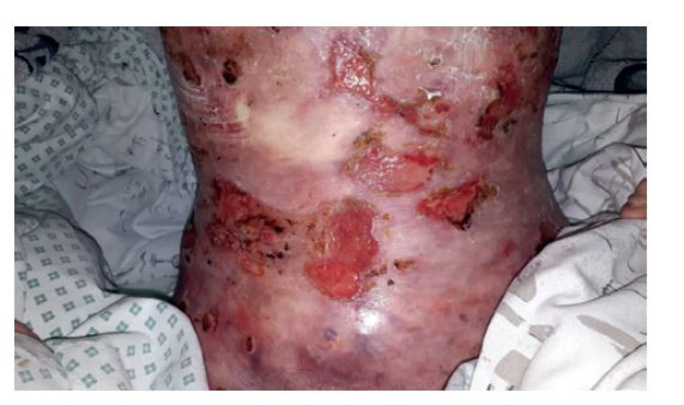 Břišní stěna po okluzi stomie<br>
Fig. 5: Abdominal wall after stoma occlusion